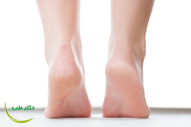 بهترین درمان ترک کف پا چیست؟